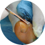 Treating ingrowing nails
